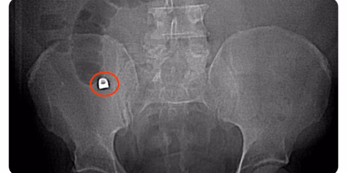 apendicitis por cuerpo extraño