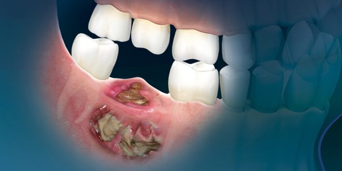 Osteonecrosis covid-19