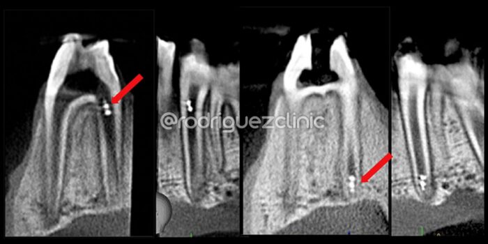 microrobots endodoncia