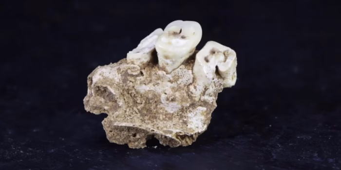 maxilar y molares prehistóricos con surcos por uso habitual de nuez de betel como evidencia de enfermedad dental